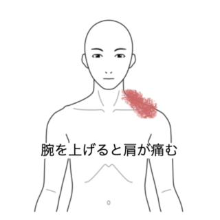 鍼灸の症例「腕を上げると左肩上部に激痛が走る」（横須賀市）