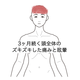 鍼灸の症例「3ヶ月続く頭全体のズキズキした痛みと眩暈」（横須賀市）