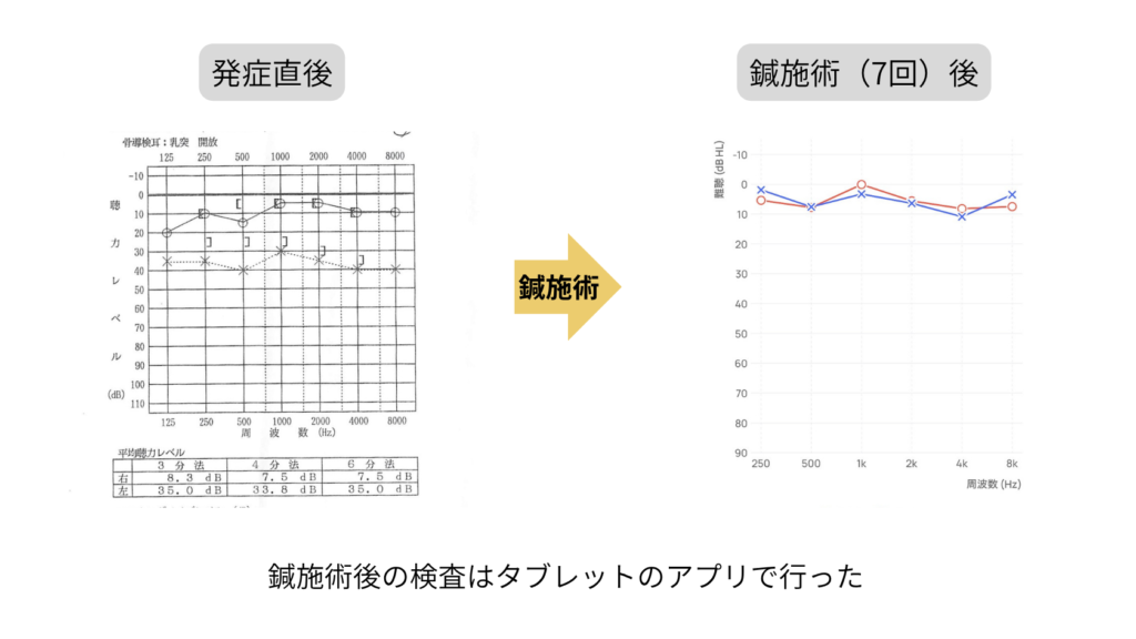突発性難聴の鍼治療で改善した聴力