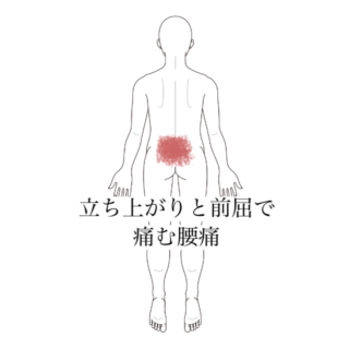 鍼灸の症例「立ち上がりと前屈で痛む腰痛」（清澄白河）