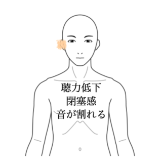 鍼灸の症例「急性感音性難聴に対する鍼治療の一症例（約2ヶ月の経過）」（沖縄県那覇市）