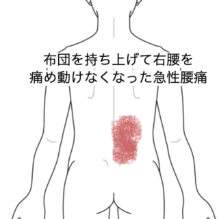 鍼灸の症例「布団を持ち上げて右腰を痛め動けなくなった急性腰痛」（JR品川駅／東京都品川区）