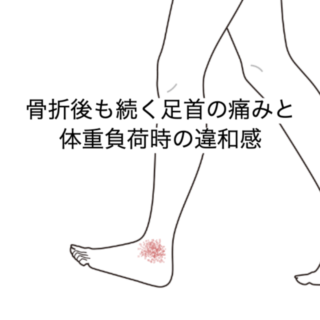 鍼灸の症例「骨折後も続く足首の痛みと体重負荷時の違和感」（群馬県伊勢崎市）