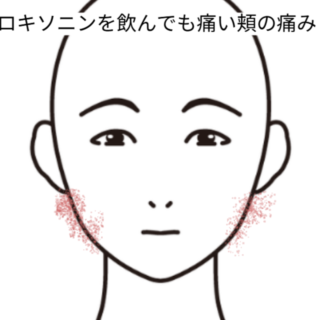 鍼灸の症例「鎮痛剤を飲んでも痛い頬の痛み」（交野市駅）