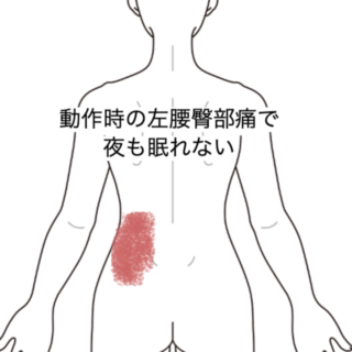 鍼灸の症例「動作時の左腰臀部痛で夜も眠れない」（JR品川駅／東京都品川区）