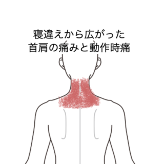 鍼灸の症例「寝違えから広がった首肩の痛みと動作時痛」（JR品川駅／東京都品川区）