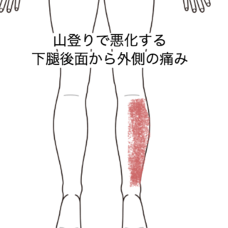 鍼灸の症例「山登りで悪化する下腿後面から外側の痛み」（JR品川駅／東京都品川区）