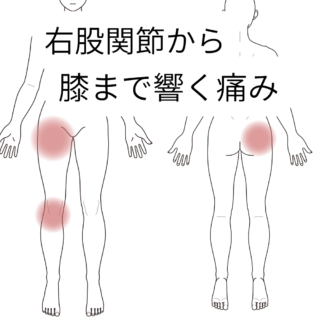 鍼灸の症例「足のつけ根から膝まで響くような痛み」（籠原駅／熊谷市）