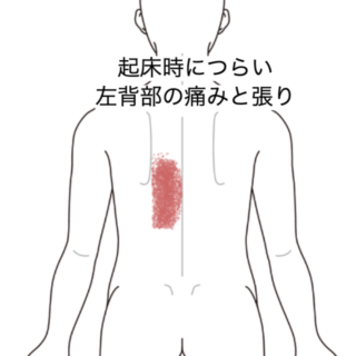 鍼灸の症例「起床時につらい左背部の痛みと張り」（JR品川駅／東京都品川区）