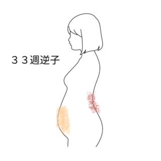 鍼灸の症例「妊娠33週の逆子、2回の鍼治療後、35週時の健診で頭位を確認」（Grote Markt/Den Haag Centrum）