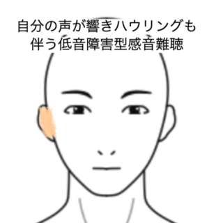 鍼灸の症例「自分の声が響きハウリングも伴う低音障害型感音難聴」（JR品川駅／東京都品川区）