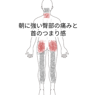鍼灸の症例「朝に強い臀部の痛みと首のつまり感」（京成本線・公津の杜）