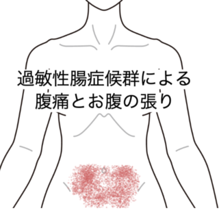 鍼灸の症例「過敏性腸症候群による腹痛とお腹の張りに対する施術例」（島根県出雲市）