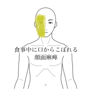 鍼灸の症例「食事中に口からこぼれる顔面麻痺」（清澄白河）