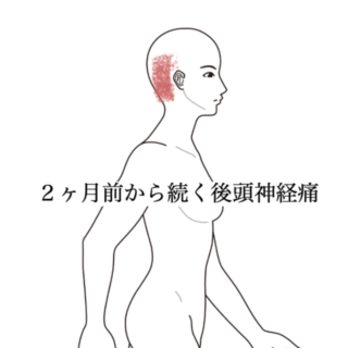 鍼灸の症例「右後頭部がビリビリする神経痛と首の緊張」（黒川駅／名古屋市北区）