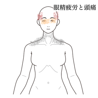 鍼灸の症例「眼精疲労からくる頭痛」（都営新宿線　船堀駅　/ 東京都江戸川区船堀）