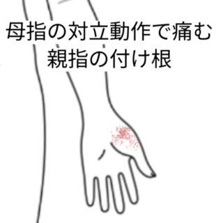 鍼灸の症例「母指の対立動作で痛む親指の付け根」（阪急芦屋川駅/兵庫県芦屋市）