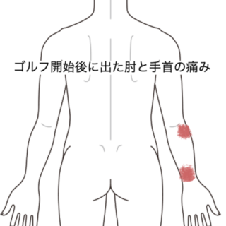 鍼灸の症例「ゴルフ開始後に出た肘と手首の痛み」（JR品川駅／東京都品川区）
