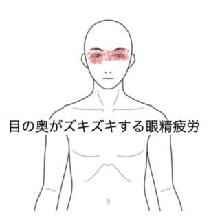 鍼灸の症例「目の奥がズキズキしてくる眼精疲労の症例」（清澄白河）