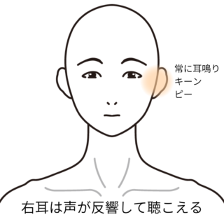 鍼灸の症例「繰り返す低音障害型感音難聴の症状」（JR千里丘駅／大阪府吹田市）