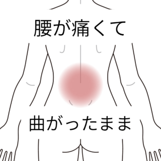 鍼灸の症例「腰を伸ばして歩くことがつらい腰痛」（籠原駅／熊谷市）