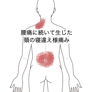 鍼灸症例｜腰痛に続いて生じた頚の寝違え様痛み｜JR品川駅／東京都品川区｜はりきゅうルーム カポス