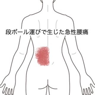 鍼灸症例｜段ボール運びで生じた急性腰痛｜JR品川駅／東京都品川区｜はりきゅうルーム カポス