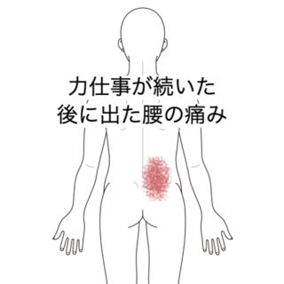 鍼灸症例｜力仕事が続いた後に出た腰の痛みに対する施術例｜島根県出雲市｜山岡鍼灸院