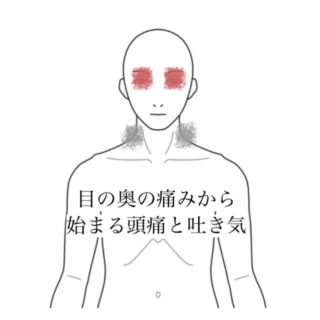 鍼灸症例|目の奥の痛みから始まる頭痛と吐き気|清澄白河|鍼灸院ひなた 清澄白河