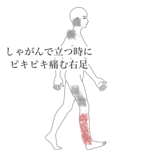 鍼灸症例｜しゃがんで立つ時にピキピキ痛む右足｜清澄白河｜鍼灸院ひなた　清澄白河