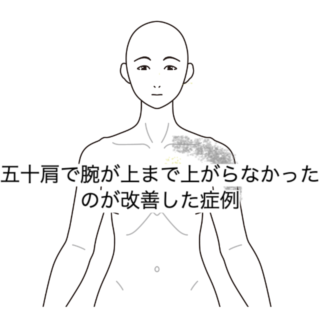 鍼灸症例｜五十肩で腕が上まで上がらなかったのが改善した症例｜清澄白河｜鍼灸院ひなた　清澄白河