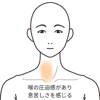 鍼灸の症例「喉を押されているような圧迫感」（JR千里丘駅／大阪府吹田市）